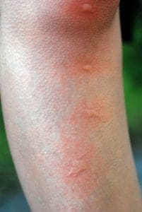 tea tree oil for bug bites